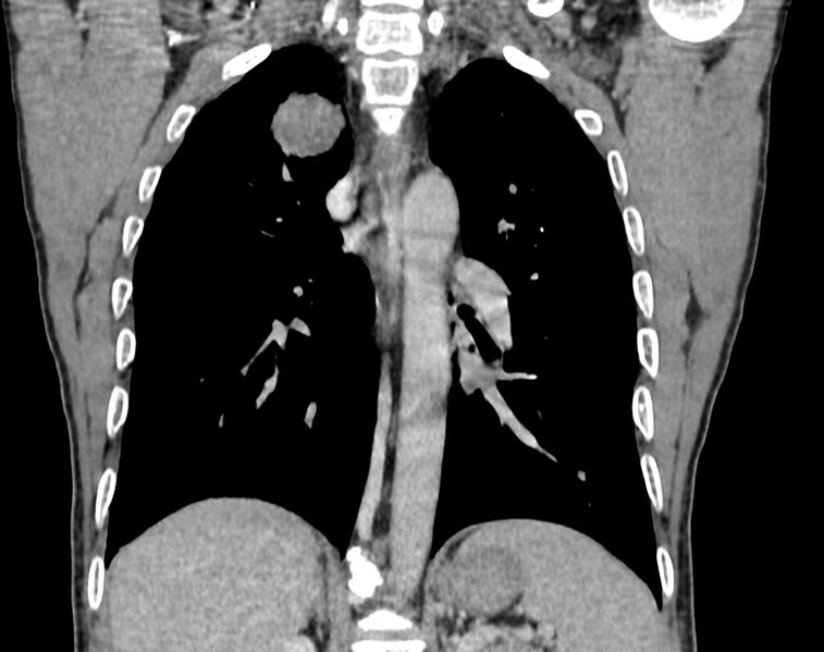 File:Bronchogenic carcinoma with superior vena cava syndrome (Radiopaedia 36497-38054 Coronal C+ delayed 69).jpg