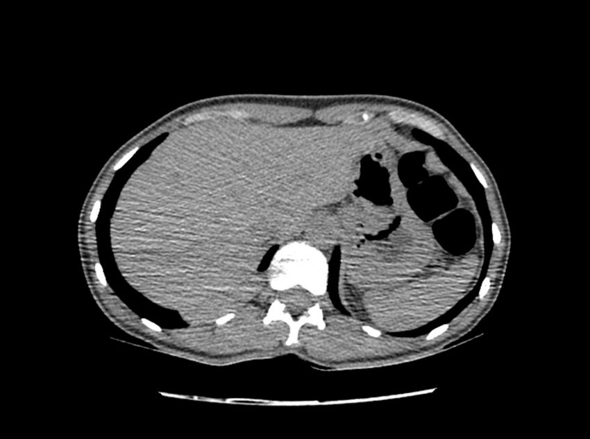Bronchogenic cyst (Radiopaedia 80273-93615 C 42).jpg