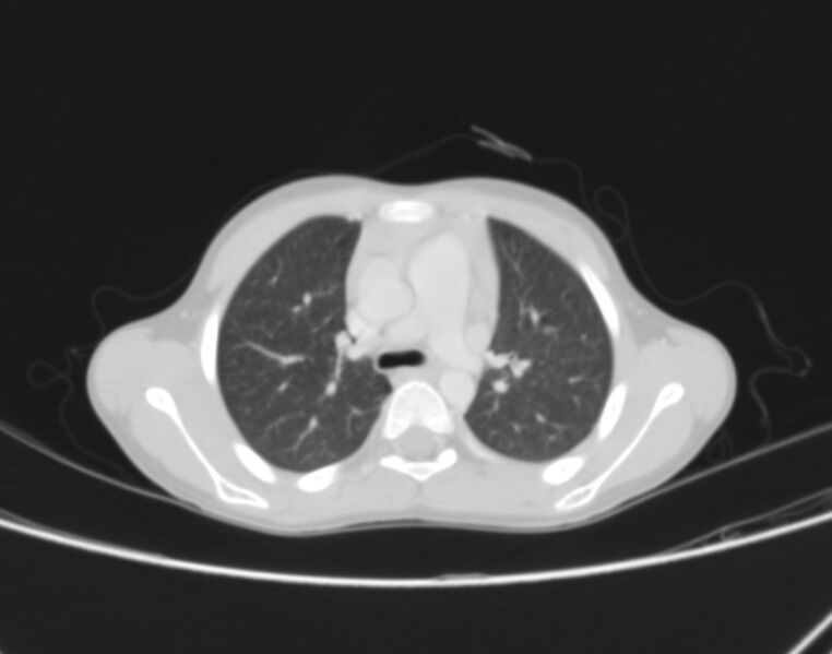 File:Bronchus suis (Radiopaedia 68131-77620 Axial lung window 25).jpg