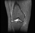 Bucket handle tear - medial meniscus (Radiopaedia 24900-25163 Coronal T2 fat sat 6).png