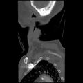 C1 anterior arch (plough) fracture - type 1 (Radiopaedia 76181-87720 Sagittal bone window 9).jpg