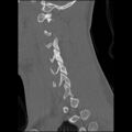 C5 facet fracture (Radiopaedia 58374-65499 Sagittal bone window 49).jpg