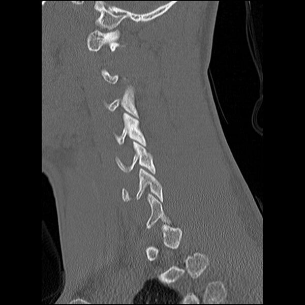 File:C5 facet fracture (Radiopaedia 58374-65499 Sagittal bone window 49).jpg