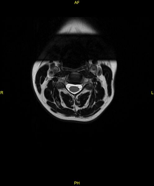 File:C5 nerve sheath tumor (Radiopaedia 85777-101596 Axial T2 10).jpg