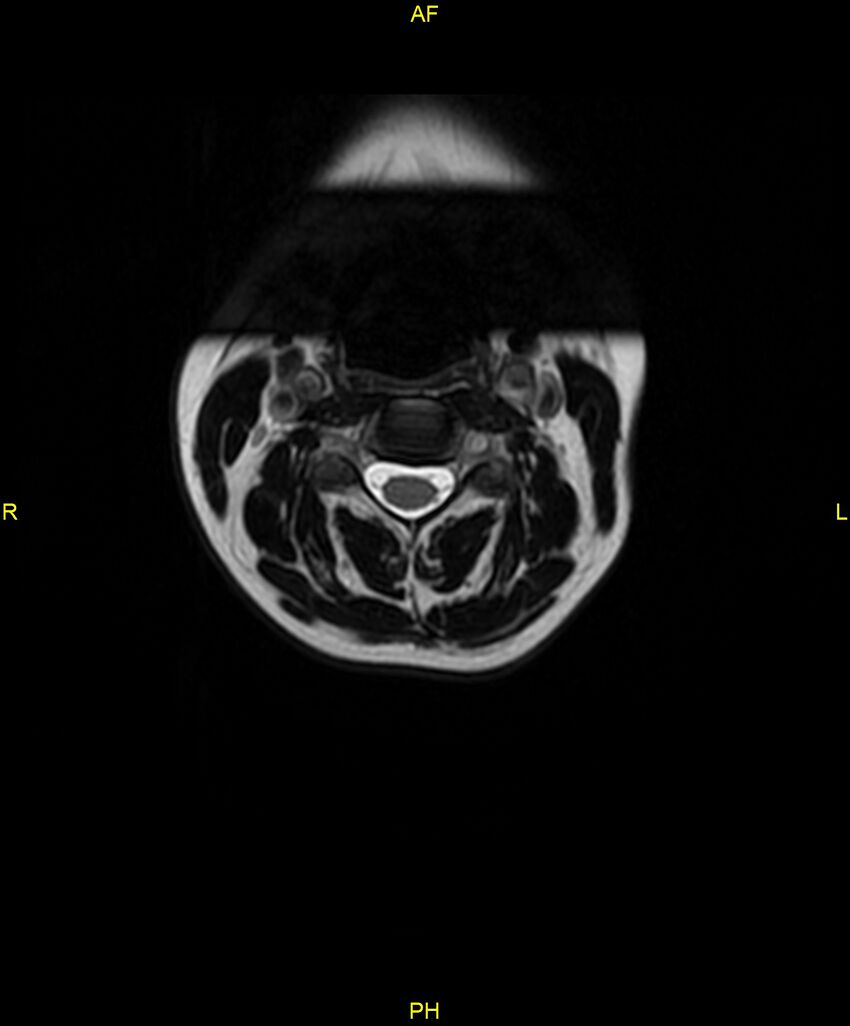C5 nerve sheath tumor (Radiopaedia 85777-101596 Axial T2 10).jpg