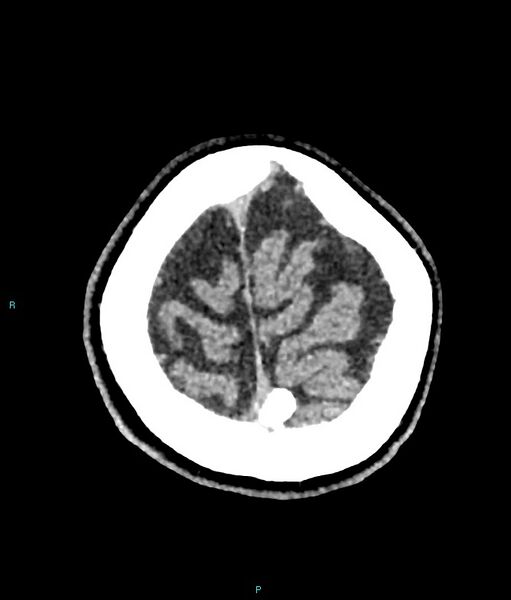 File:Calcified cerebral emboli from left ventricular thrombus (Radiopaedia 84420-99758 Axial non-contrast 13).jpg