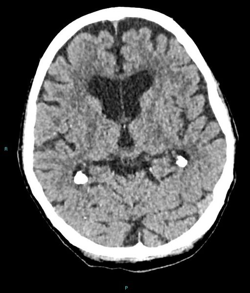 File:Calcified cerebral emboli from left ventricular thrombus (Radiopaedia 84420-99758 Axial non-contrast 52).jpg