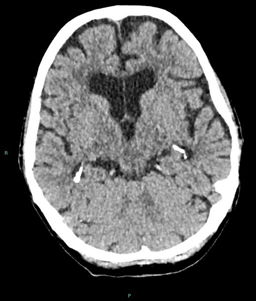 File:Calcified cerebral emboli from left ventricular thrombus (Radiopaedia 84420-99758 Axial non-contrast 57).jpg