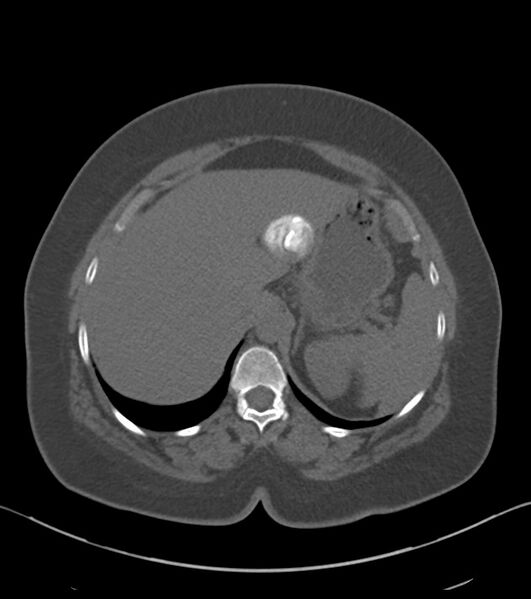 File:Calcified hepatic hydatid cyst (Radiopaedia 81127-94738 Axial non-contrast 22).jpg