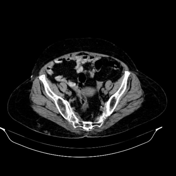 File:Calcified hydatid cyst (Radiopaedia 62000-70085 Axial non-contrast 89).jpg