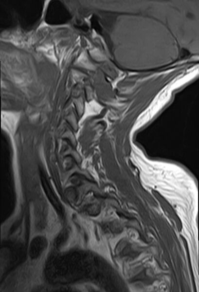 File:Calcified meningioma - cervical canal (Radiopaedia 70136-82468 Sagittal T1 11).jpg