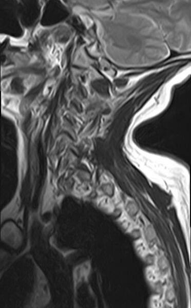 File:Calcified meningioma - cervical canal (Radiopaedia 70136-82468 Sagittal T2 3).jpg