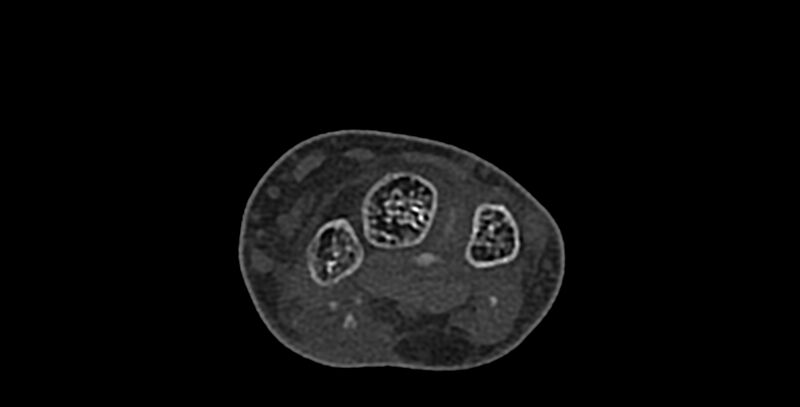 File:Calcifying aponeurotic fibroma (Radiopaedia 88423-105064 Axial bone window 71).jpg