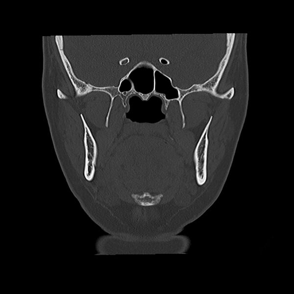 File:Canal up mastoidectomy (Radiopaedia 78108-90638 Coronal bone window 20).jpg