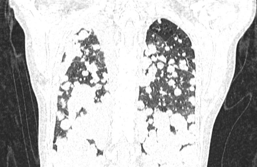 Cannonball metastases from breast cancer (Radiopaedia 91024-108569 Coronal lung window 117).jpg