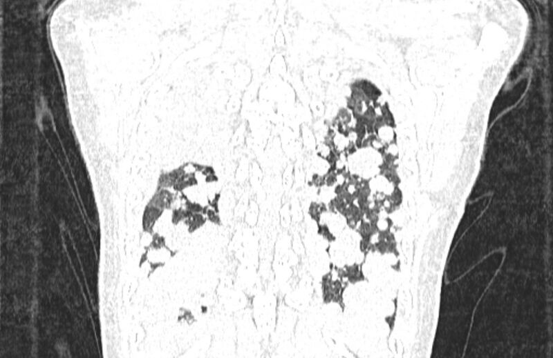File:Cannonball metastases from breast cancer (Radiopaedia 91024-108569 Coronal lung window 128).jpg