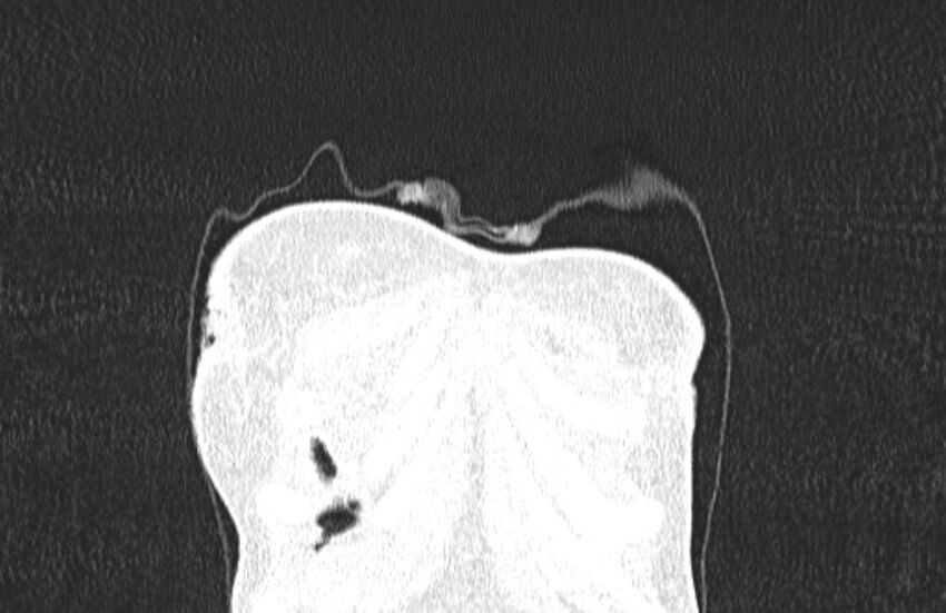 Cannonball metastases from breast cancer (Radiopaedia 91024-108569 Coronal lung window 8).jpg