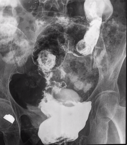 File:Carcinoma of rectum (Radiopaedia 27843-28085 D 1).PNG