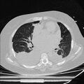 Cardiogenic pulmonary edema (Radiopaedia 29213-29609 Axial lung window 52).jpg
