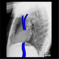 Cardiomediastinal anatomy on chest radiography (annotated images) (Radiopaedia 46331-50772 B 1).png
