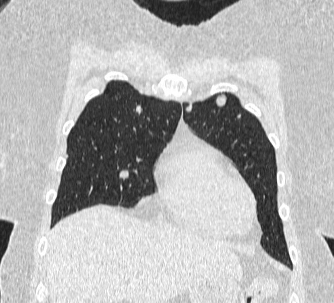 File:Cavitating pulmonary metastases (Radiopaedia 17796-17555 Coronal lung window 1).jpg