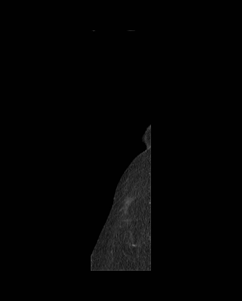 Cecal volvulus (Radiopaedia 54998-61310 C 85).jpg