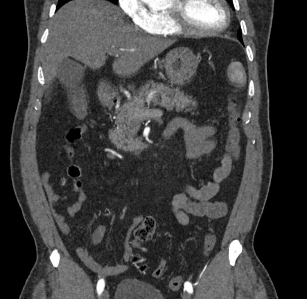 File:Celiac artery dissection (Radiopaedia 52194-58080 C 23).jpg