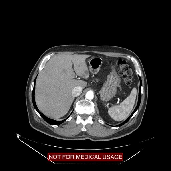 File:Celiac trunk variant anatomy - gastrohepatic trunk and splenic artery (Radiopaedia 38815-40995 A 7).jpg