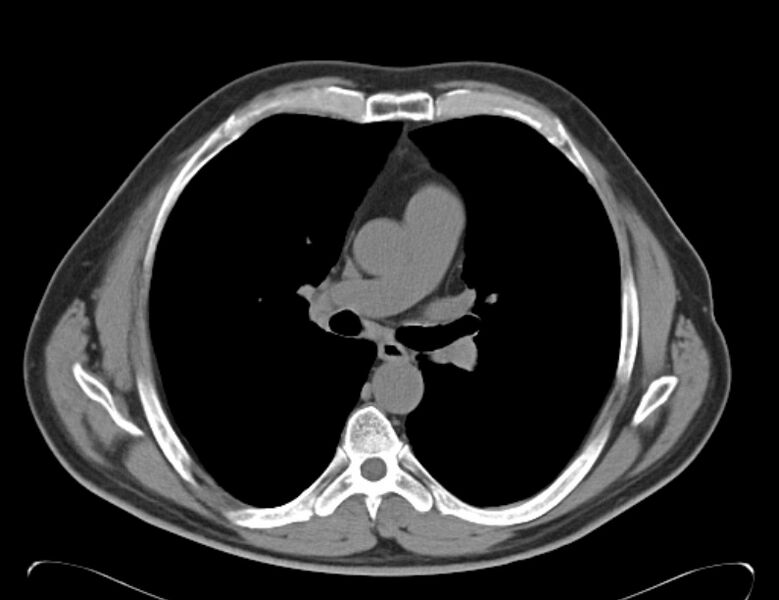 File:Centrilobular pulmonary emphysema (Radiopaedia 26808-26971 Axial non-contrast 21).jpg