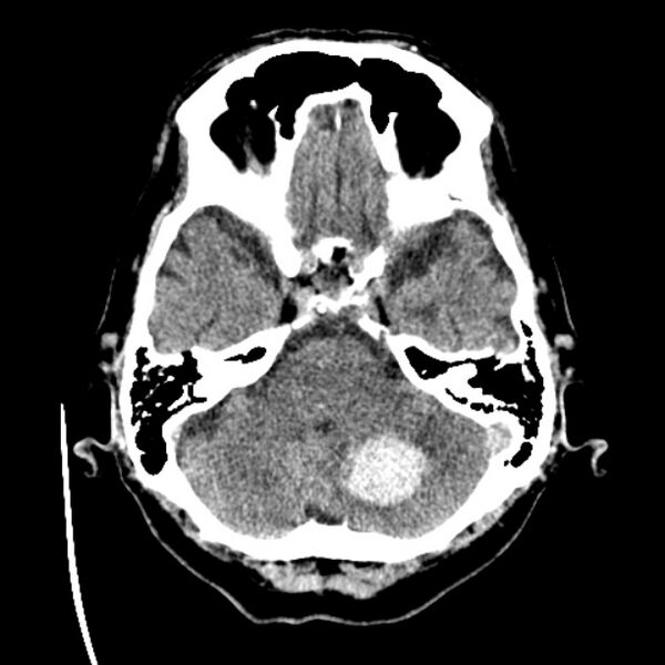File:Cerebellar hemorrhage (Radiopaedia 27193-27359 Axial non-contrast 11).jpg