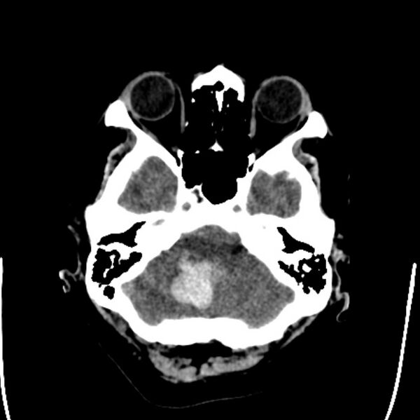 File:Cerebellar hemorrhage causing obstructive hydrocephalus (Radiopaedia 33989-35207 Axial non-contrast 9).jpg