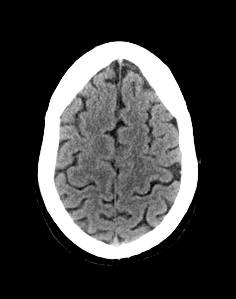File:Cerebellar infarct due to vertebral artery dissection with posterior fossa decompression (Radiopaedia 82779-97033 Axial non-contrast 29).png