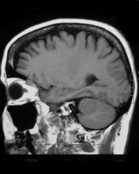 File:Cerebellopontine angle meningioma (Radiopaedia 2597-6293 Sagittal T1 1).jpg