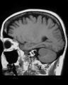 Cerebellopontine angle meningioma (Radiopaedia 2597-6293 Sagittal T1 1).jpg