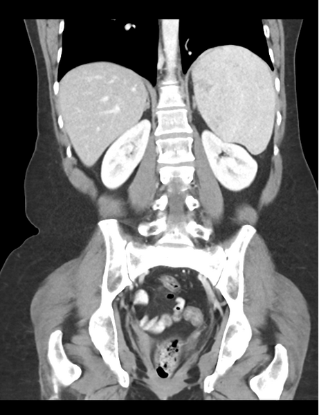 File:Cerebral abscess from pulmonary arteriovenous malformation (Radiopaedia 86275-102292 D 35).png