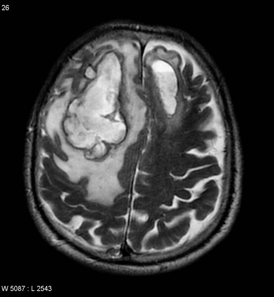 File:Cerebral abscesses secondary to contusions (Radiopaedia 5201-6968 Axial T2 7).jpg