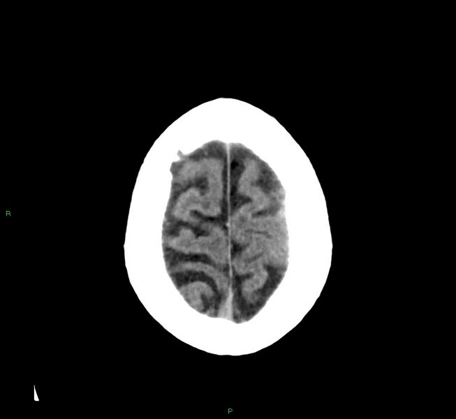 File:Cerebral amyloid angiopathy-associated lobar intracerebral hemorrhage (Radiopaedia 58376-65511 Axial non-contrast 10).jpg