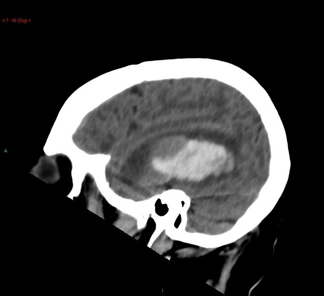 File:Cerebral amyloid angiopathy-associated lobar intracerebral hemorrhage (Radiopaedia 58378-65518 C 48).jpg