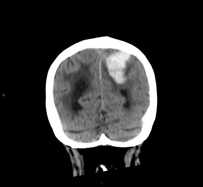 File:Cerebral amyloid angiopathy-associated lobar intracerebral hemorrhage (Radiopaedia 58530-65688 Coronal non-contrast 18).jpg