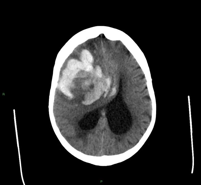 File:Cerebral amyloid angiopathy-associated lobar intracerebral hemorrhage (Radiopaedia 58560-65723 Axial non-contrast 19).jpg