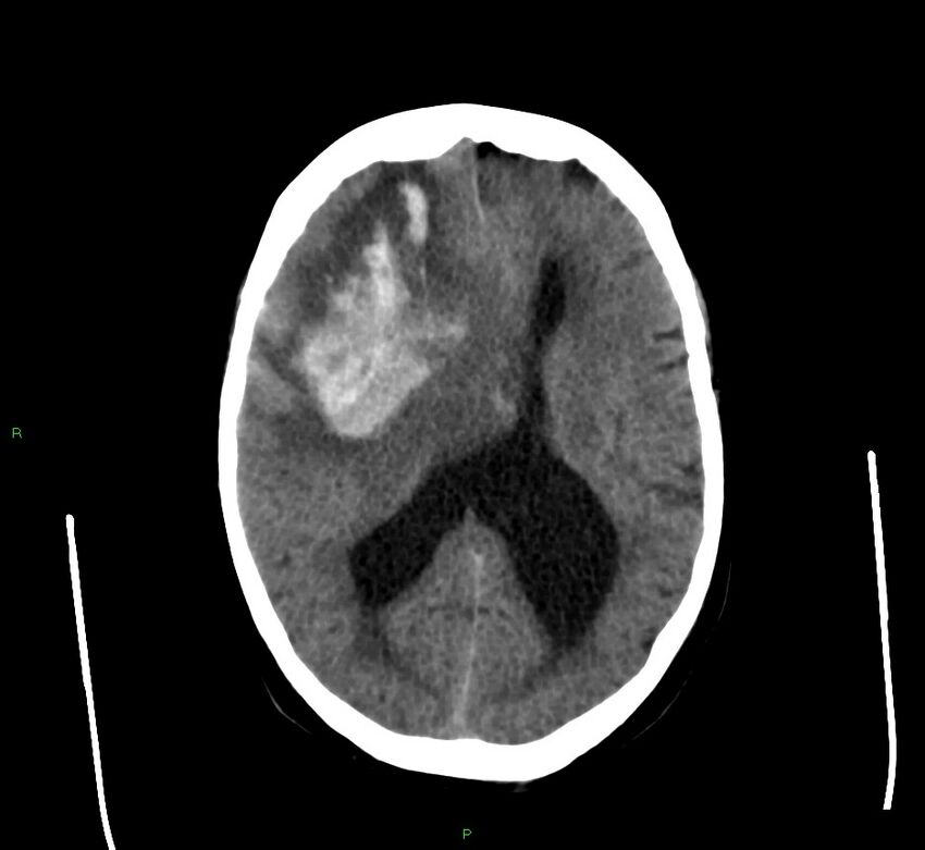 Cerebral amyloid angiopathy-associated lobar intracerebral hemorrhage (Radiopaedia 58560-65723 Axial non-contrast 24).jpg