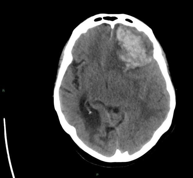 File:Cerebral amyloid angiopathy-associated lobar intracerebral hemorrhage (Radiopaedia 58561-65724 Axial non-contrast 27).jpg