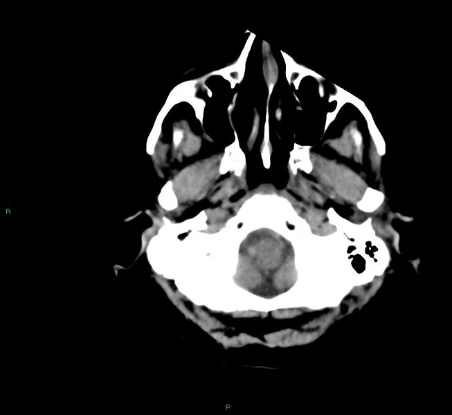 File:Cerebral amyloid angiopathy-associated lobar intracerebral hemorrhage (Radiopaedia 58561-65724 Axial non-contrast 42).jpg