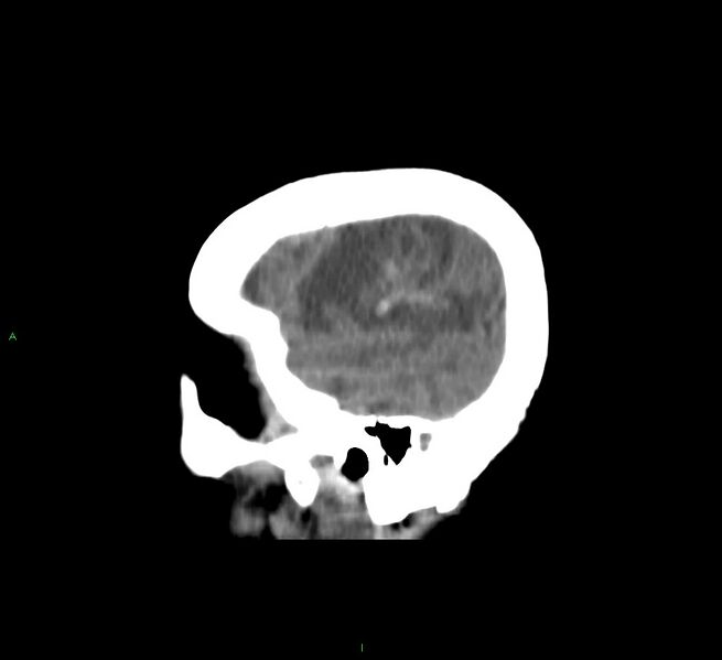 File:Cerebral amyloid angiopathy-associated lobar intracerebral hemorrhage (Radiopaedia 58751-65972 C 10).jpg