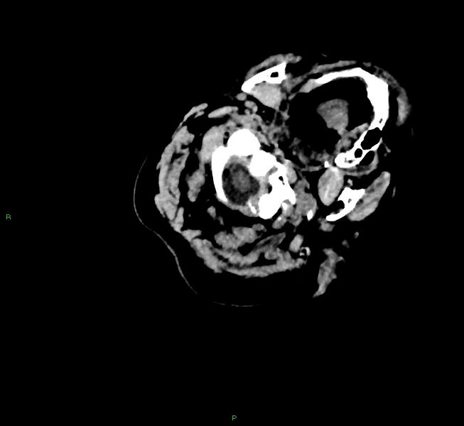File:Cerebral amyloid angiopathy-associated lobar intracerebral hemorrhage (Radiopaedia 58757-65979 Axial non-contrast 5).jpg