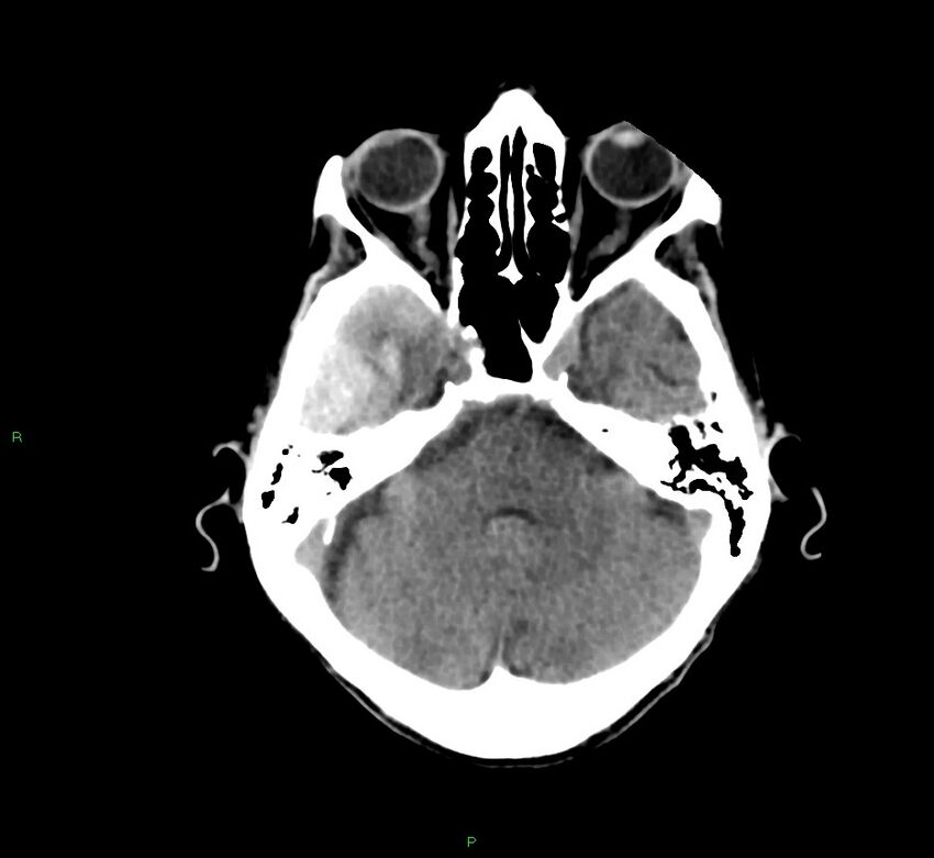 Cerebral amyloid angiopathy-associated lobar intracerebral hemorrhage (Radiopaedia 58758-65980 Axial non-contrast 37).jpg