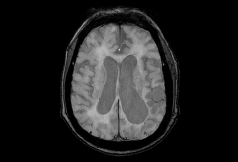 File:Cerebral amyloid angiopathy (Radiopaedia 86671-102792 Axial Gradient Echo 22).jpg