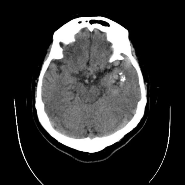 File:Cerebral arteriovenous malformation (Radiopaedia 43729-47189 Axial non-contrast 14).jpg