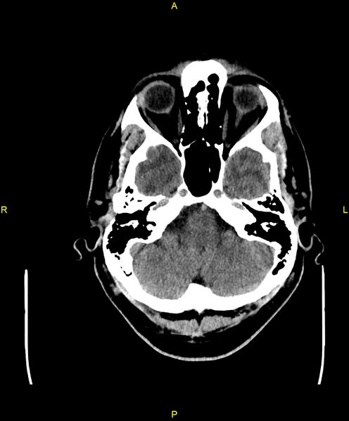 File:Cerebral autosomal dominant arteriopathy with subcortical infarcts and leukoencephalopathy (CADASIL) (Radiopaedia 86108-102051 Axial non-contrast 19).jpg