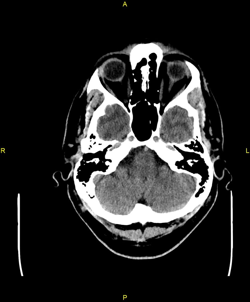 Cerebral autosomal dominant arteriopathy with subcortical infarcts and leukoencephalopathy (CADASIL) (Radiopaedia 86108-102051 Axial non-contrast 19).jpg